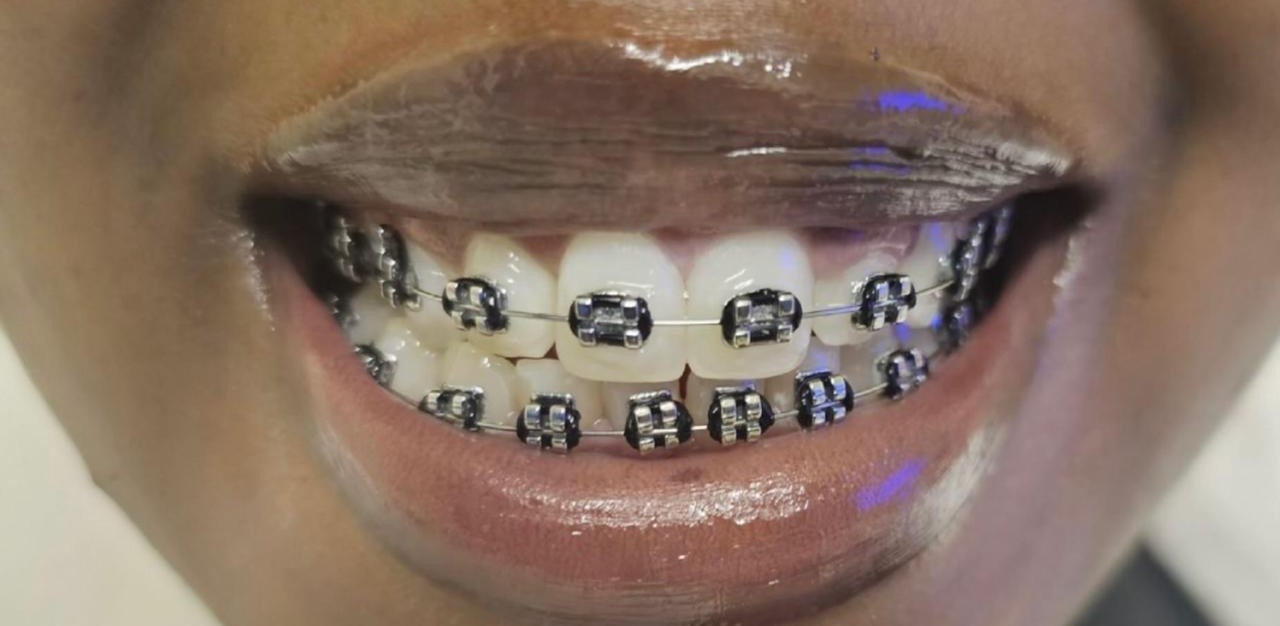 Braces after