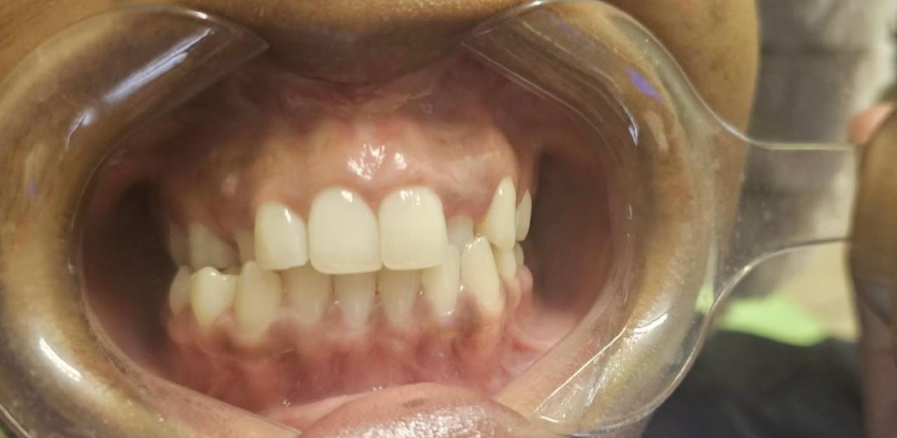 Braces before