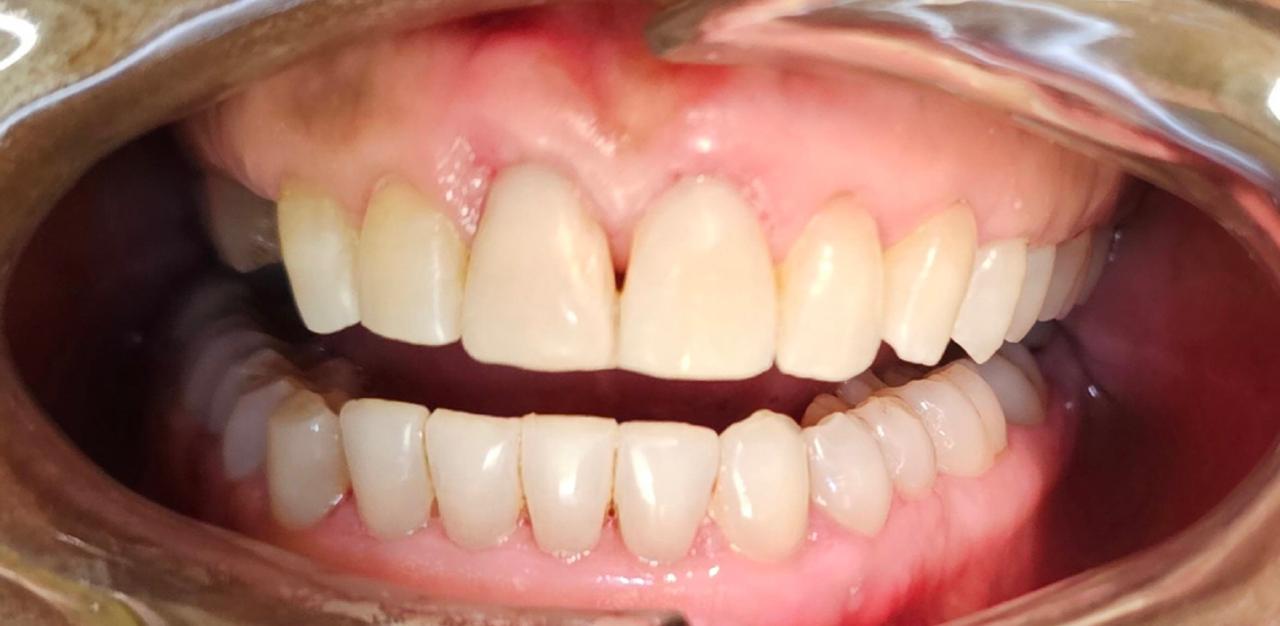 Composite veneer after