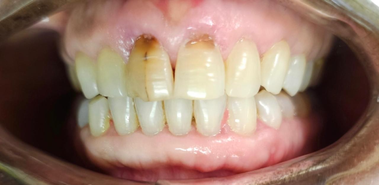 Composite veneer before