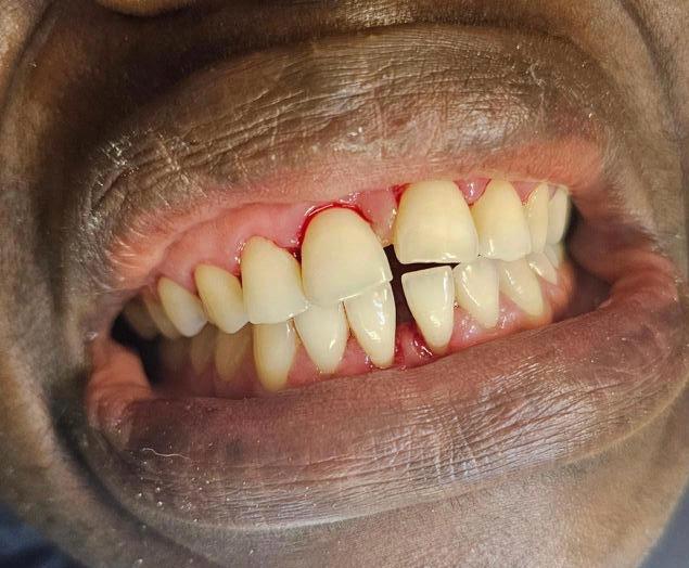 Internal bleaching after