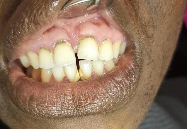 Internal bleaching before