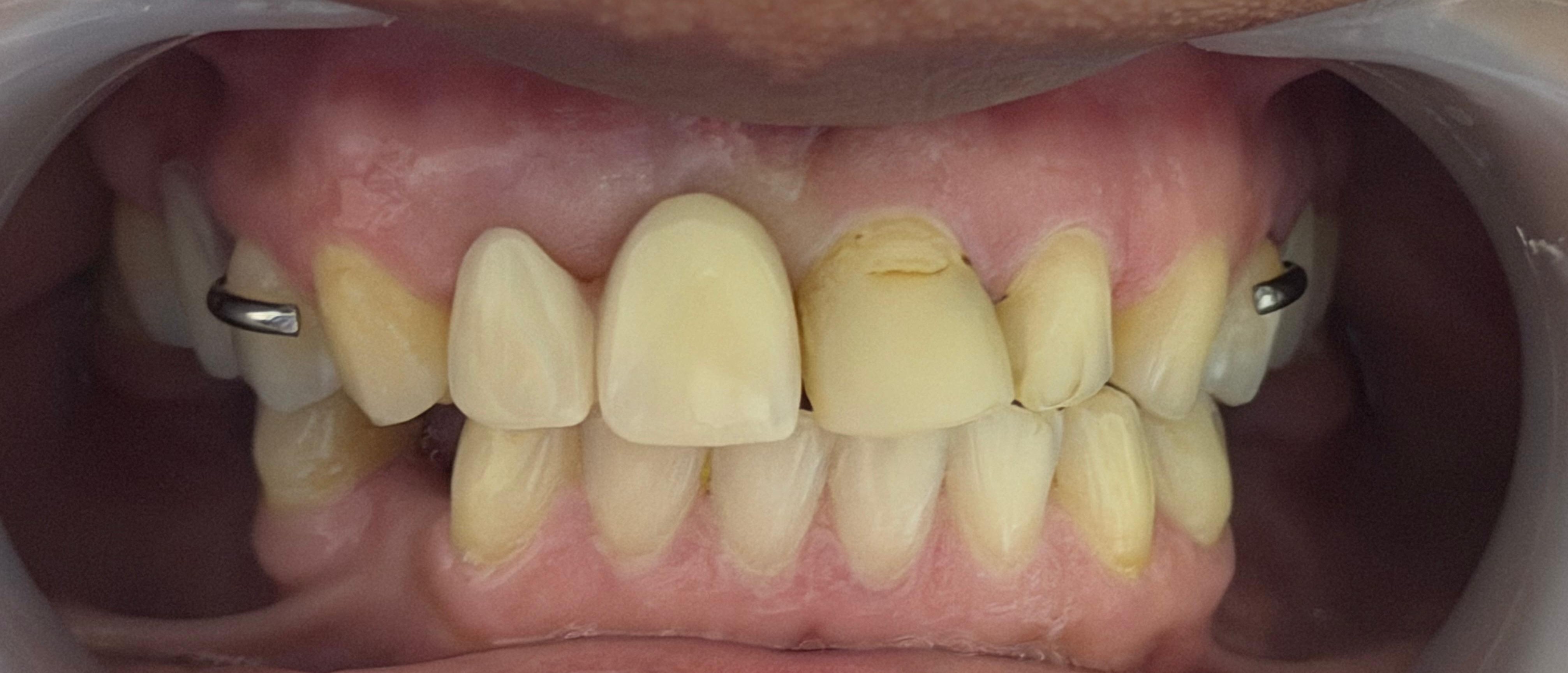 Dentures after
