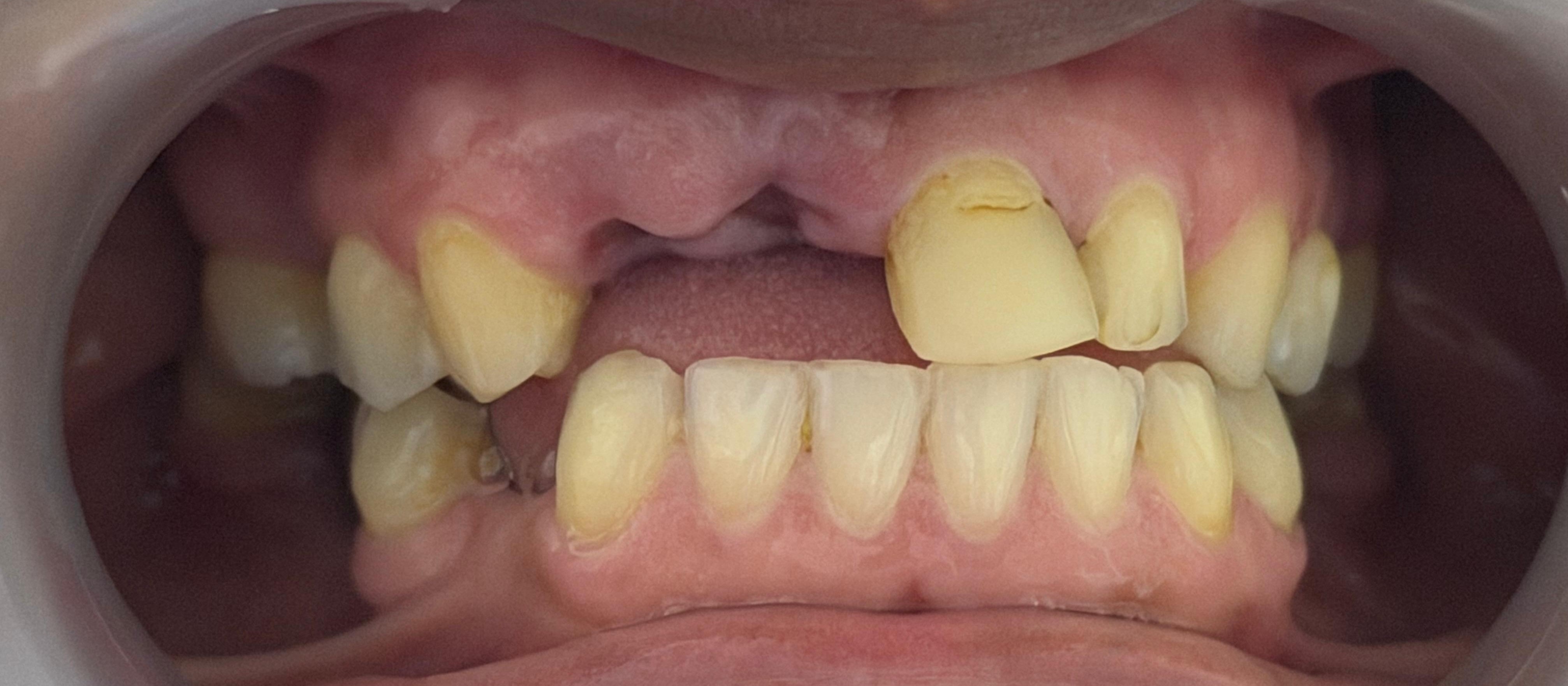 Dentures before