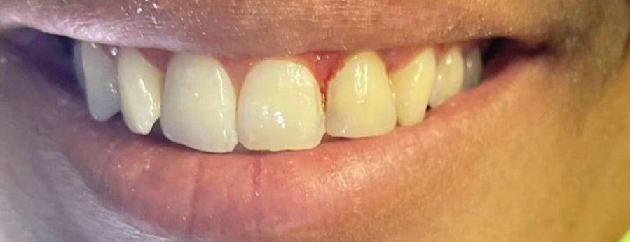 Gold removal after