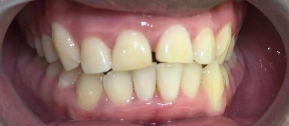 Internal bleaching after