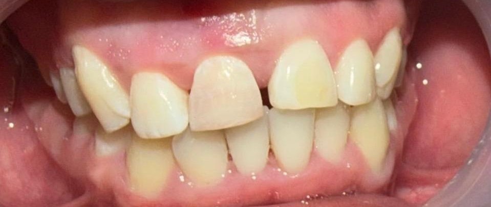 Internal bleaching before
