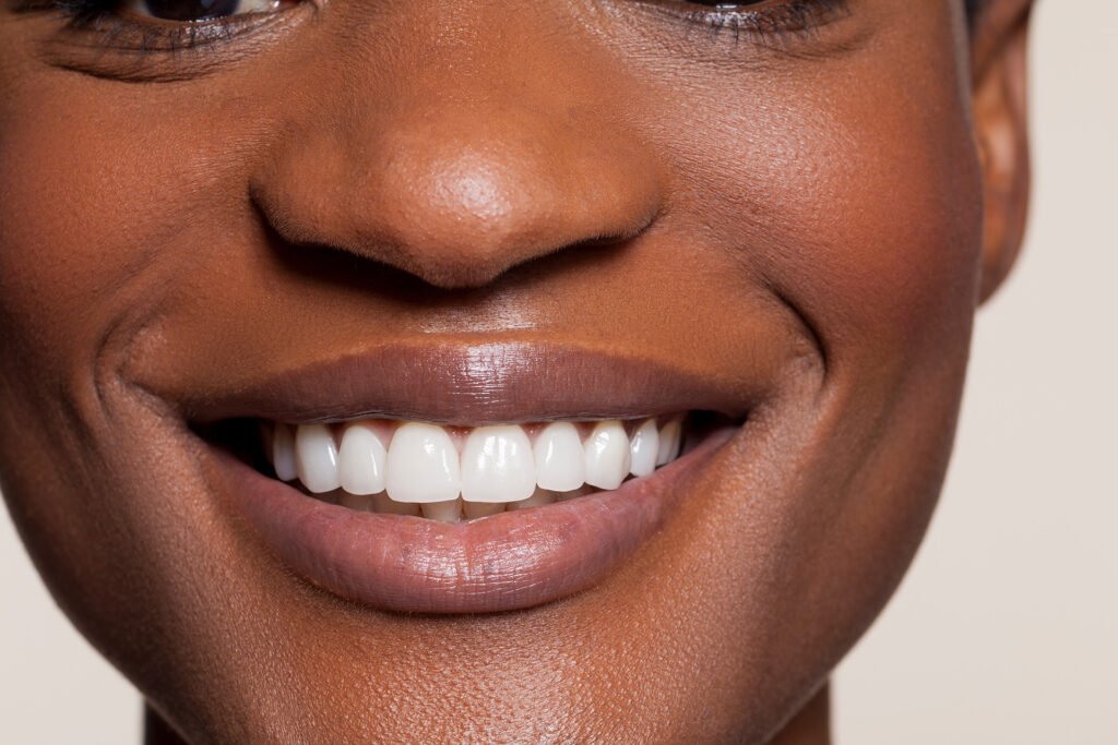 Teeth Whitening